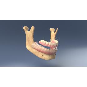 3D Denture with Dental Implants